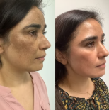 Korean Wrapping Peel Off Mask (Bay 1 Get 1 Free)